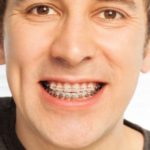 ceramic braces, orthodontist, Woodbridge NJ